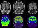 Panel: MRI Negative Epilepsy 